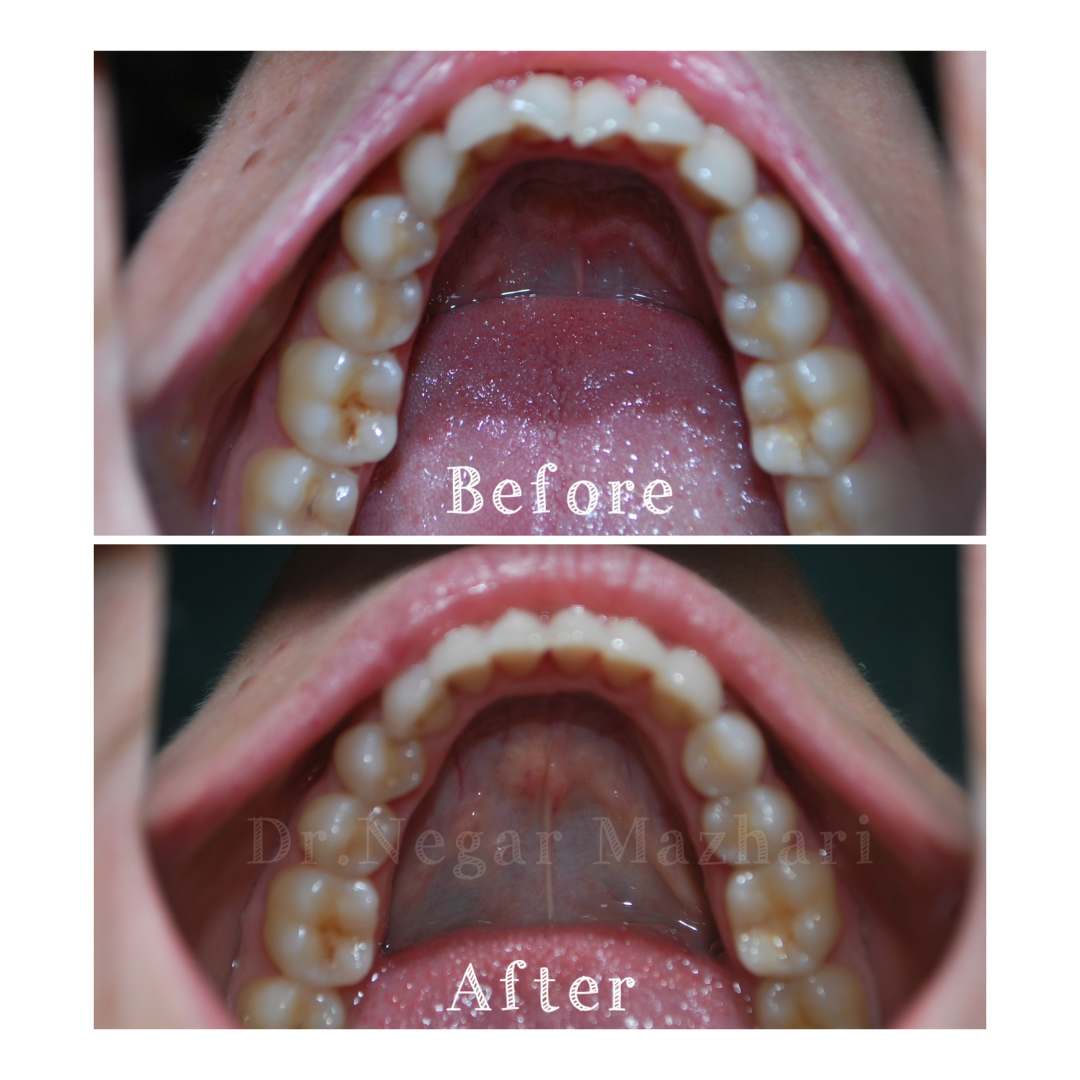 18Invisalign.jpg