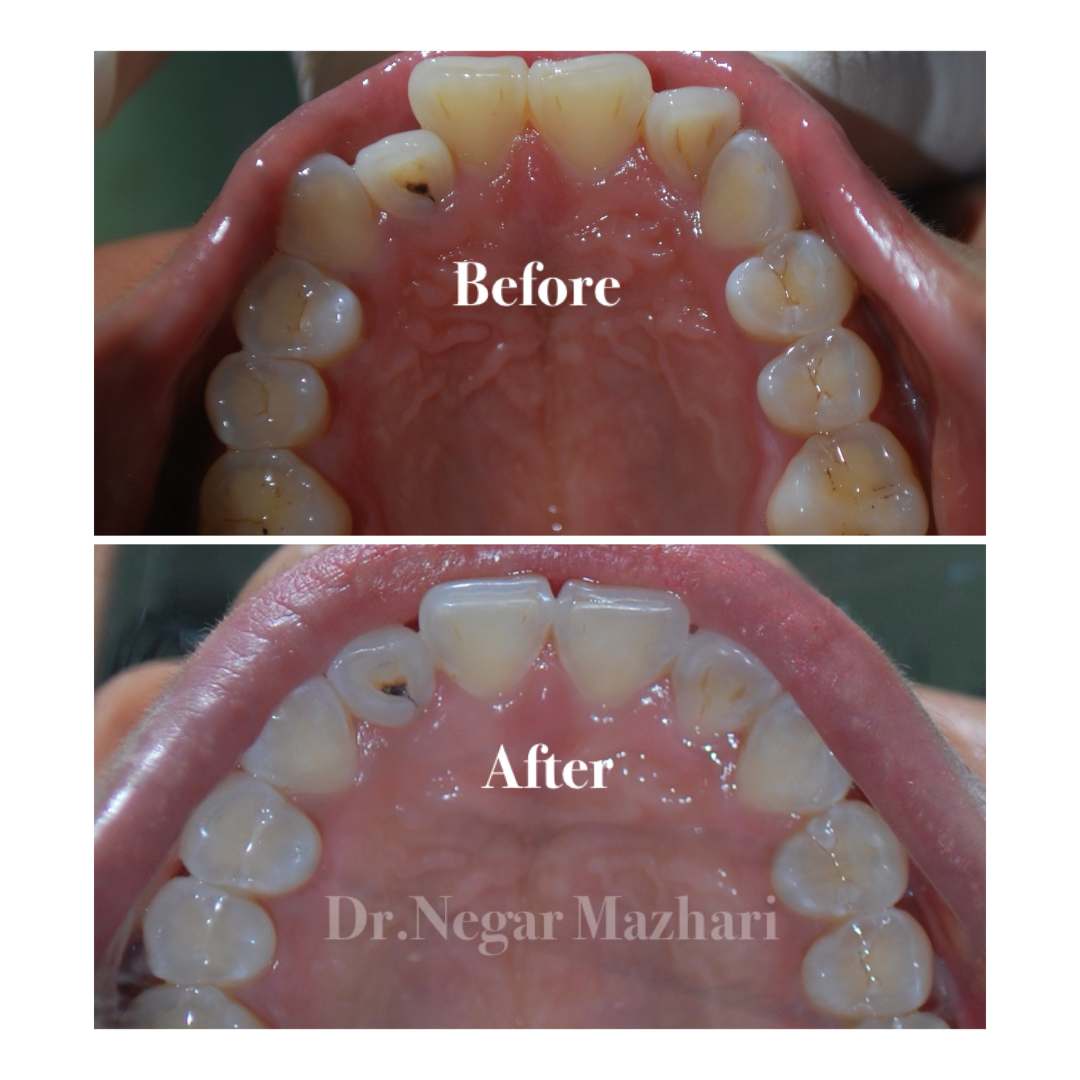 25Invisalign.jpg