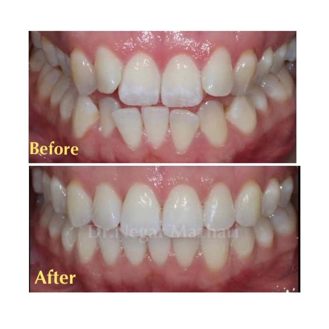 29Invisalign.jpg